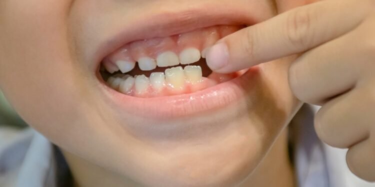 Do Baby Teeth Have Roots