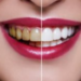 Can Yellow Teeth Be Whitened