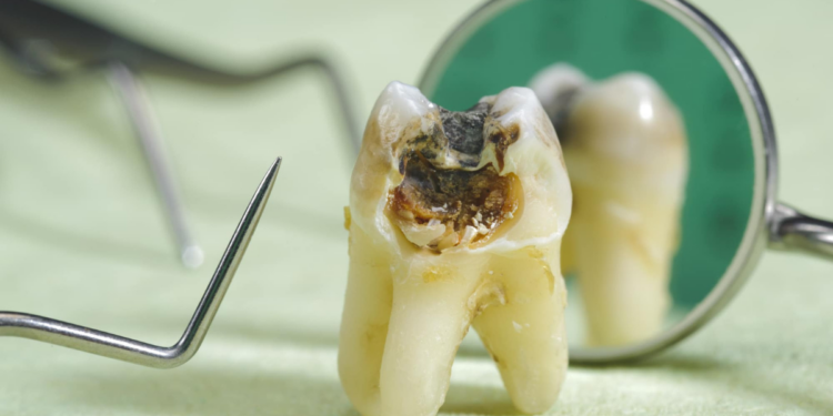 Does Grinding Teeth Cause Cavities