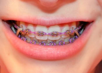 How Do Elastics Move Teeth