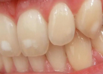 How To Remove Calcium Deposits On Teeth