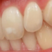 How To Remove Calcium Deposits On Teeth
